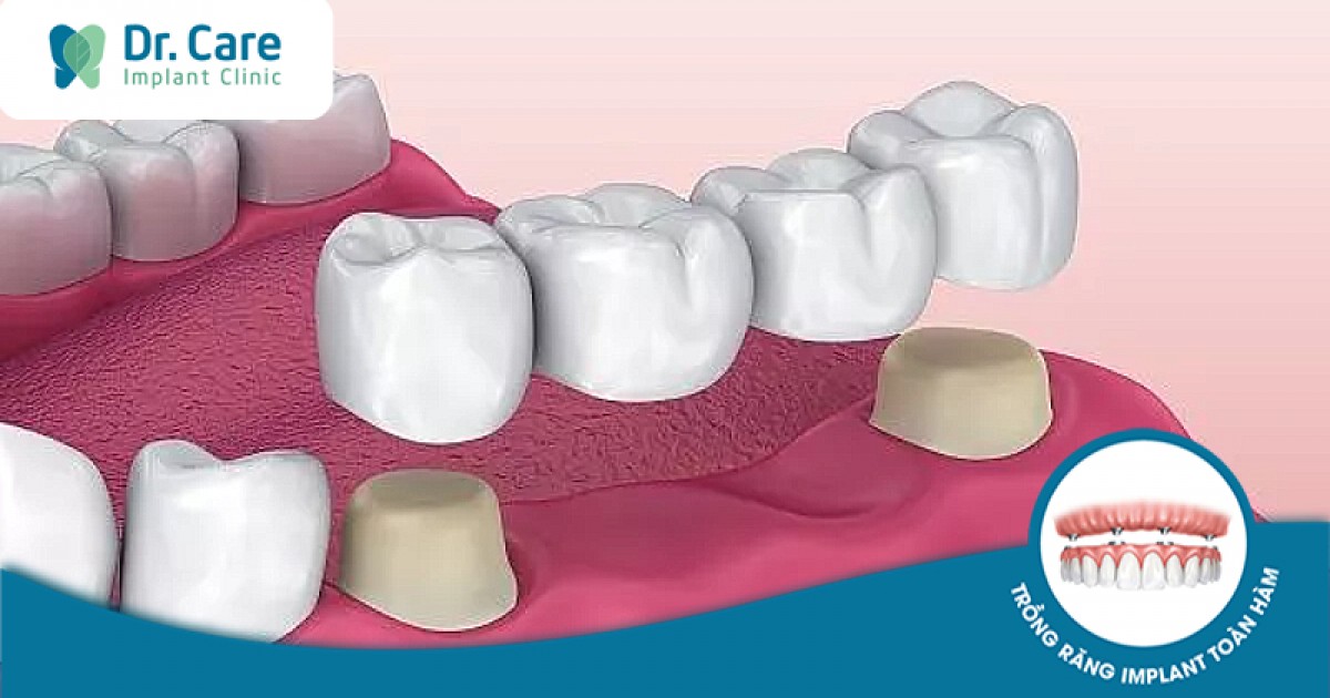 Bị tiêu xương răng và cần tìm giải pháp thay thế cầu răng sứ