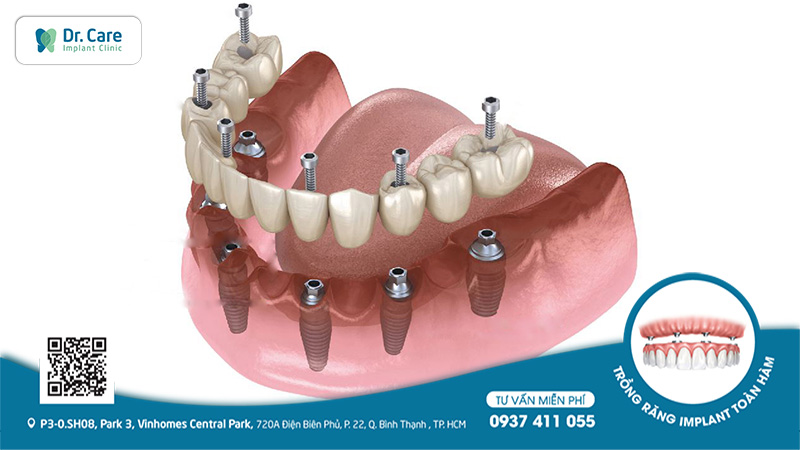 Trồng Implant duy trì xương hàm sau mất răng