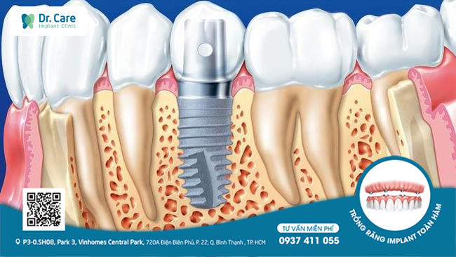 Trồng Implant phục hồi xương sau mất răng